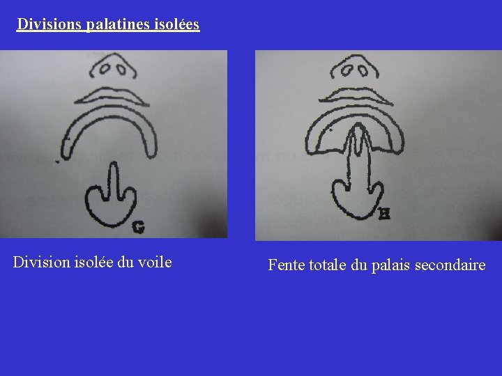 Divisions palatines isolées Division isolée du voile Fente totale du palais secondaire Divisions palatines isolées Division isolée du voile Fente totale du palais secondaire