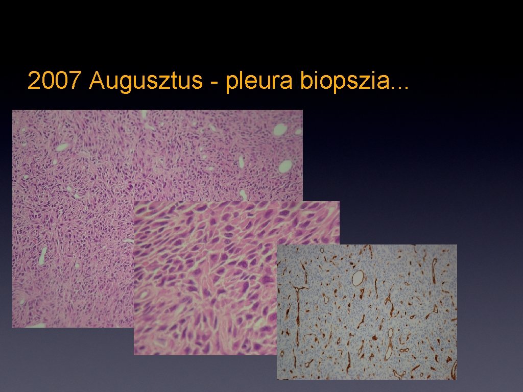 2007 Augusztus - pleura biopszia. . . 