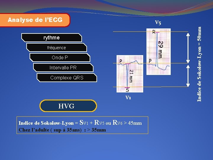 Analyse de l’ECG rythme fréquence Onde P Intervalle PR Complexe QRS V 1 HVG