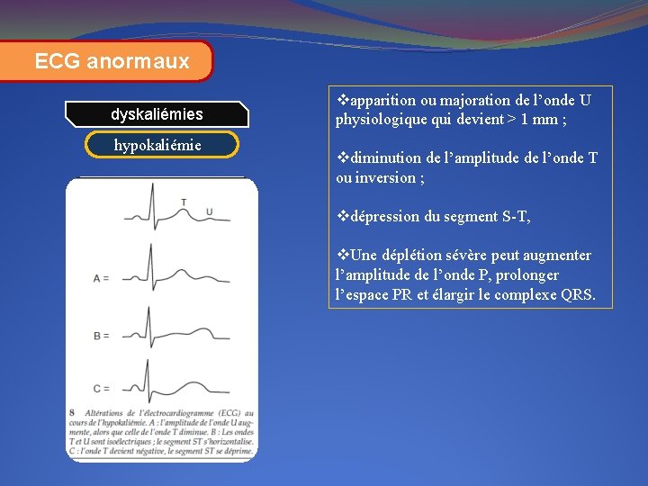 ECG anormaux dyskaliémies hypokaliémie vapparition ou majoration de l’onde U physiologique qui devient >