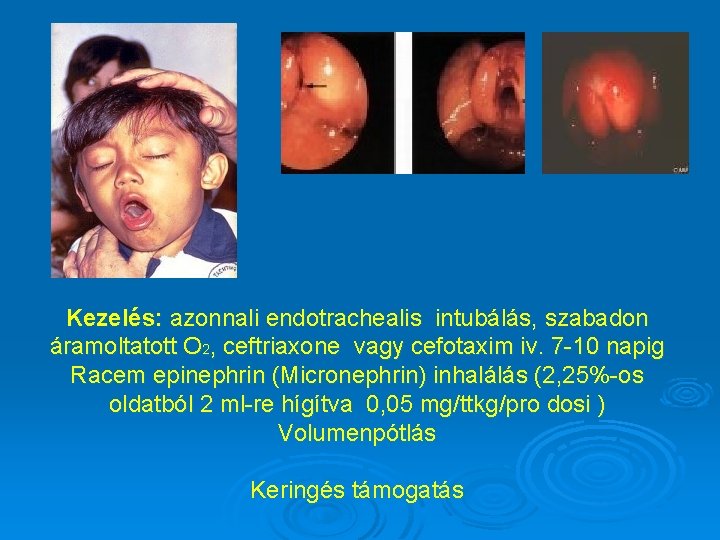 Kezelés: azonnali endotrachealis intubálás, szabadon áramoltatott O 2, ceftriaxone vagy cefotaxim iv. 7 -10