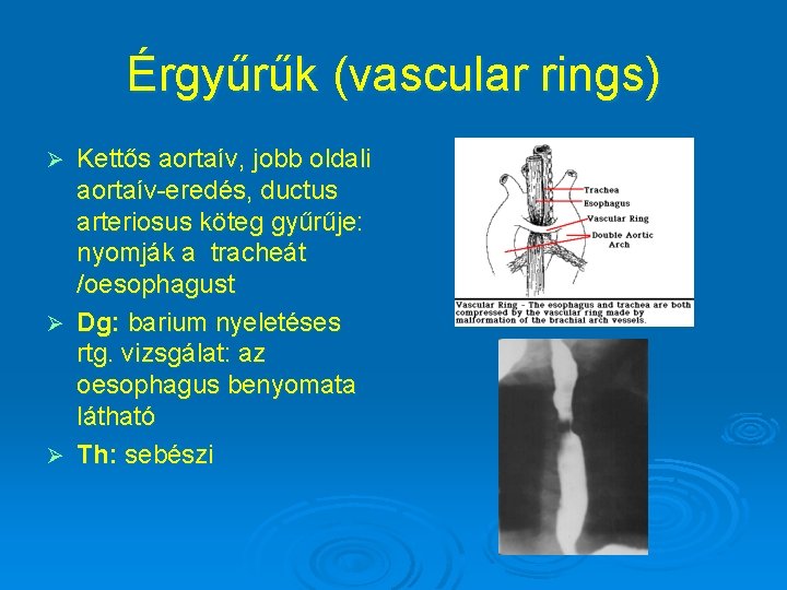 Érgyűrűk (vascular rings) Kettős aortaív, jobb oldali aortaív-eredés, ductus arteriosus köteg gyűrűje: nyomják a