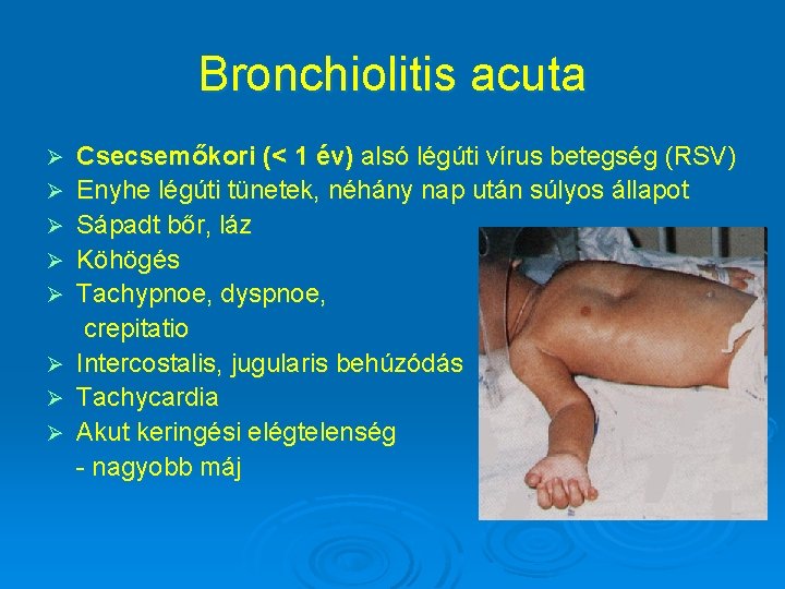 Bronchiolitis acuta Ø Ø Ø Ø Csecsemőkori (< 1 év) alsó légúti vírus betegség