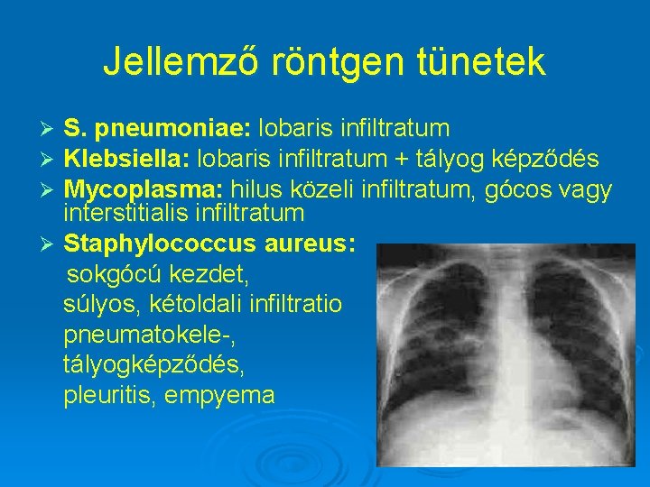 Jellemző röntgen tünetek S. pneumoniae: lobaris infiltratum Klebsiella: lobaris infiltratum + tályog képződés Mycoplasma: