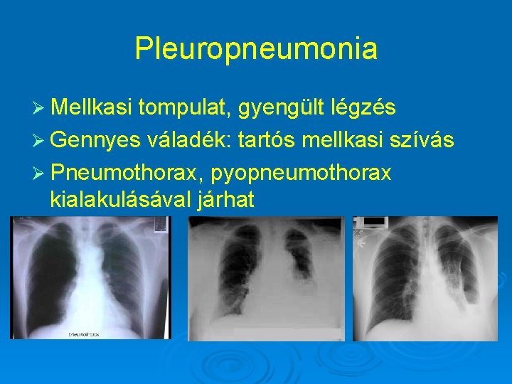 Pleuropneumonia Ø Mellkasi tompulat, gyengült légzés Ø Gennyes váladék: tartós mellkasi szívás Ø Pneumothorax,