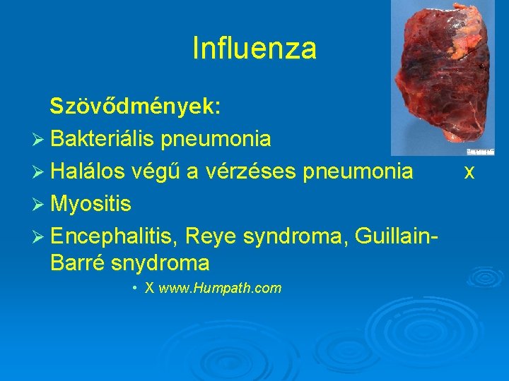Influenza Szövődmények: Ø Bakteriális pneumonia Ø Halálos végű a vérzéses pneumonia Ø Myositis Ø