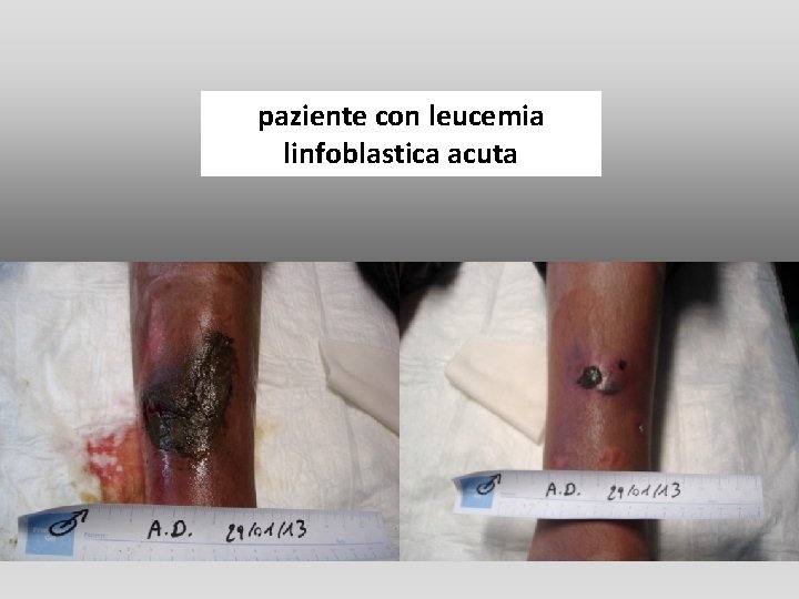 paziente con leucemia linfoblastica acuta paziente con leucemia linfoblastica acuta