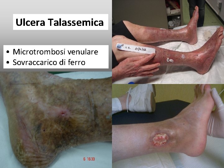 Ulcera Talassemica • Microtrombosi venulare • Sovraccarico di ferro Ulcera Talassemica • Microtrombosi venulare • Sovraccarico di ferro