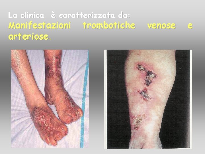 La clinica è caratterizzata da: Manifestazioni trombotiche arteriose. venose e La clinica è caratterizzata da: Manifestazioni trombotiche arteriose. venose e
