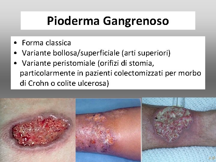 Pioderma Gangrenoso • Forma classica • Variante bollosa/superficiale (arti superiori) • Variante peristomiale (orifizi Pioderma Gangrenoso • Forma classica • Variante bollosa/superficiale (arti superiori) • Variante peristomiale (orifizi