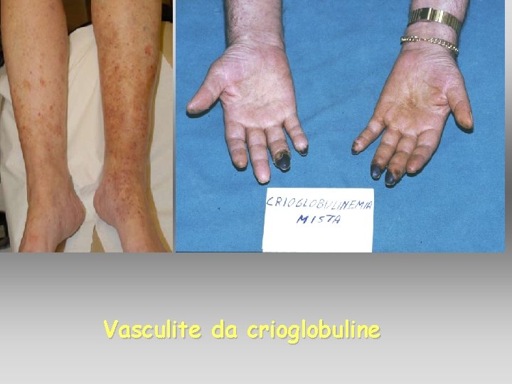 Vasculite da crioglobuline Vasculite da crioglobuline