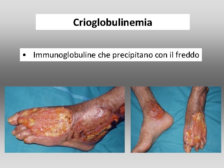 Crioglobulinemia • Immunoglobuline che precipitano con il freddo Crioglobulinemia • Immunoglobuline che precipitano con il freddo