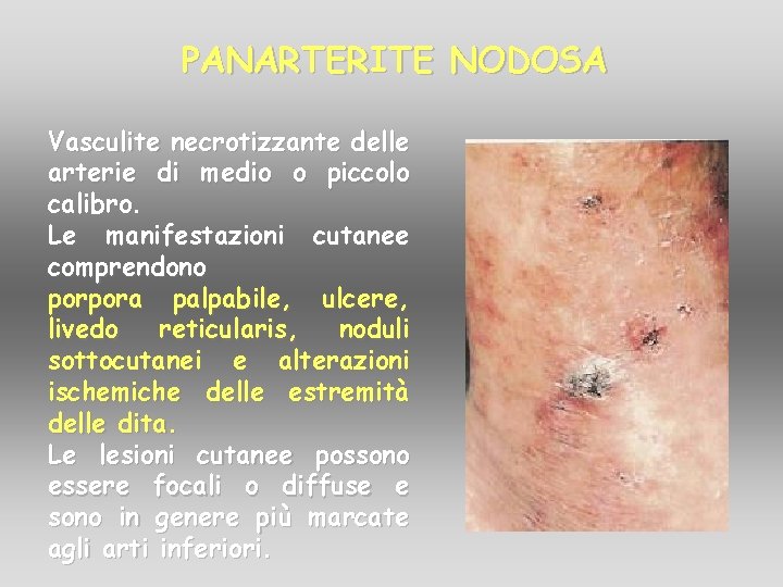 PANARTERITE NODOSA Vasculite necrotizzante delle arterie di medio o piccolo calibro. Le manifestazioni cutanee PANARTERITE NODOSA Vasculite necrotizzante delle arterie di medio o piccolo calibro. Le manifestazioni cutanee