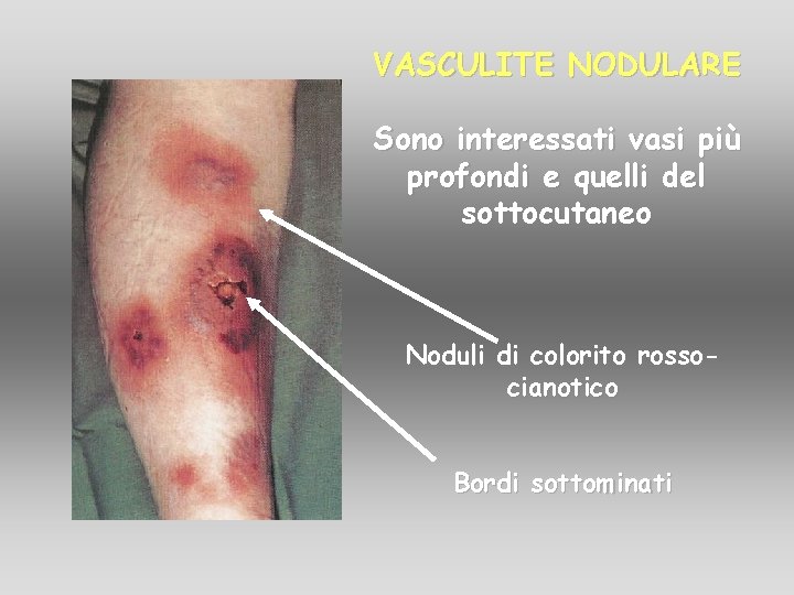 VASCULITE NODULARE Sono interessati vasi più profondi e quelli del sottocutaneo Noduli di colorito VASCULITE NODULARE Sono interessati vasi più profondi e quelli del sottocutaneo Noduli di colorito