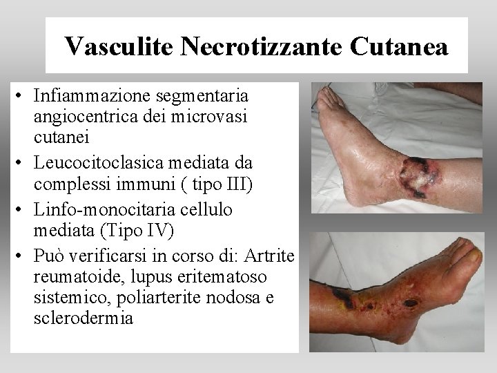 Vasculite Necrotizzante Cutanea • Infiammazione segmentaria angiocentrica dei microvasi cutanei • Leucocitoclasica mediata da Vasculite Necrotizzante Cutanea • Infiammazione segmentaria angiocentrica dei microvasi cutanei • Leucocitoclasica mediata da