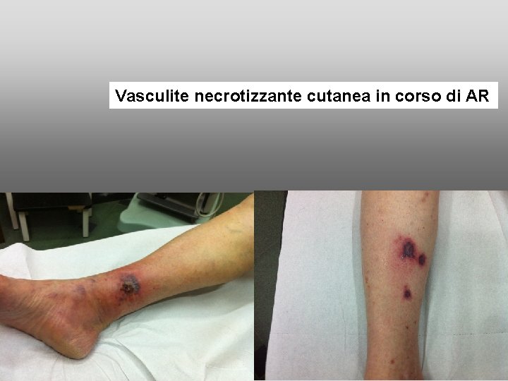Vasculite necrotizzante cutanea in corso di AR Vasculite necrotizzante cutanea in corso di AR