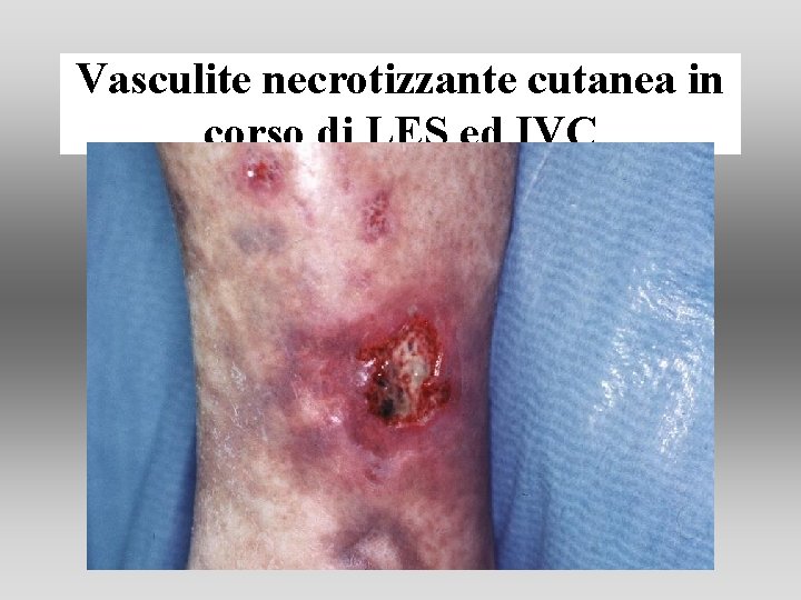 Vasculite necrotizzante cutanea in corso di LES ed IVC Vasculite necrotizzante cutanea in corso di LES ed IVC