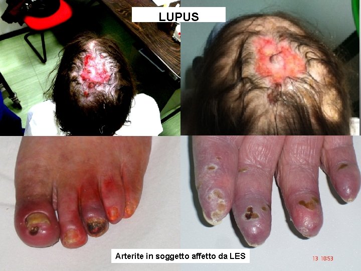 LUPUS Arterite in soggetto affetto da LES Arteriolite digitale LUPUS Arterite in soggetto affetto da LES Arteriolite digitale