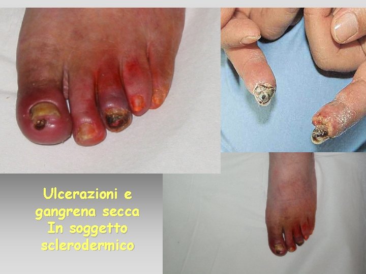 Ulcerazioni e gangrena secca In soggetto sclerodermico Ulcerazioni e gangrena secca In soggetto sclerodermico