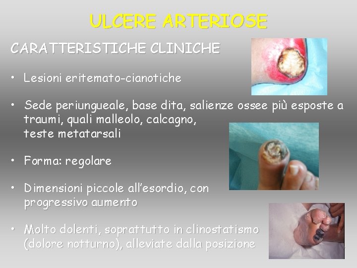 ULCERE ARTERIOSE CARATTERISTICHE CLINICHE • Lesioni eritemato-cianotiche • Sede periungueale, base dita, salienze ossee ULCERE ARTERIOSE CARATTERISTICHE CLINICHE • Lesioni eritemato-cianotiche • Sede periungueale, base dita, salienze ossee