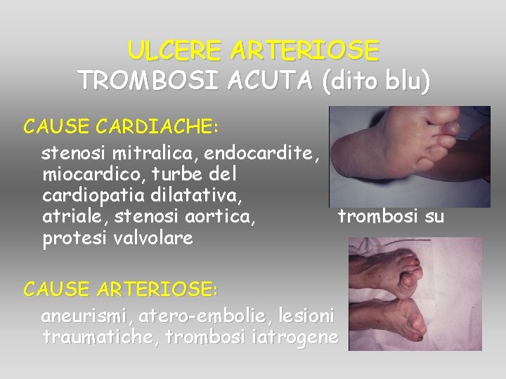 ULCERE ARTERIOSE TROMBOSI ACUTA (dito blu) CAUSE CARDIACHE: stenosi mitralica, endocardite, infarto miocardico, turbe ULCERE ARTERIOSE TROMBOSI ACUTA (dito blu) CAUSE CARDIACHE: stenosi mitralica, endocardite, infarto miocardico, turbe