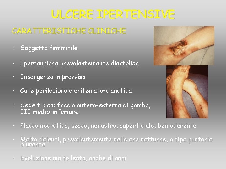 ULCERE IPERTENSIVE CARATTERISTICHE CLINICHE • Soggetto femminile • Ipertensione prevalentemente diastolica • Insorgenza improvvisa ULCERE IPERTENSIVE CARATTERISTICHE CLINICHE • Soggetto femminile • Ipertensione prevalentemente diastolica • Insorgenza improvvisa