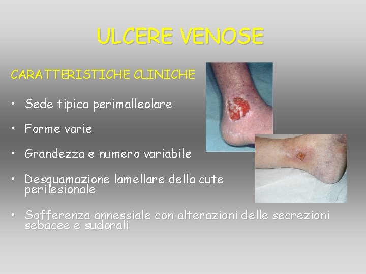 ULCERE VENOSE CARATTERISTICHE CLINICHE • Sede tipica perimalleolare • Forme varie • Grandezza e ULCERE VENOSE CARATTERISTICHE CLINICHE • Sede tipica perimalleolare • Forme varie • Grandezza e
