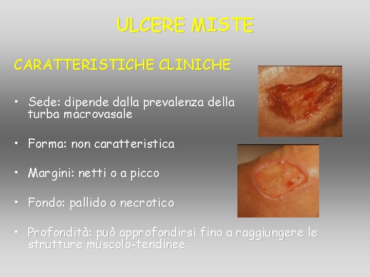 ULCERE MISTE CARATTERISTICHE CLINICHE • Sede: dipende dalla prevalenza della turba macrovasale • Forma: ULCERE MISTE CARATTERISTICHE CLINICHE • Sede: dipende dalla prevalenza della turba macrovasale • Forma: