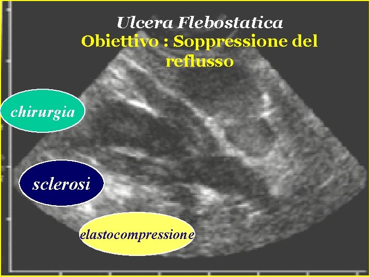 Ulcera Flebostatica Obiettivo : Soppressione del reflusso chirurgia sclerosi elastocompressione Ulcera Flebostatica Obiettivo : Soppressione del reflusso chirurgia sclerosi elastocompressione