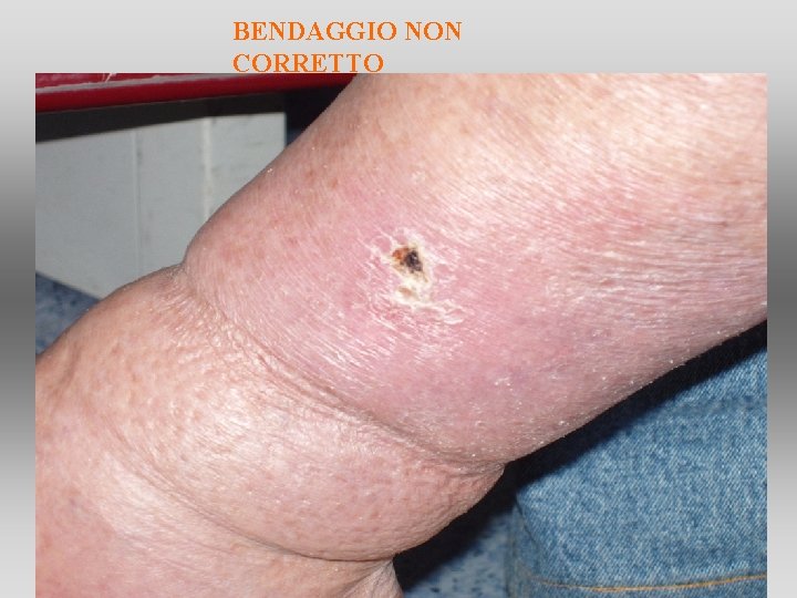 BENDAGGIO NON CORRETTO BENDAGGIO NON CORRETTO