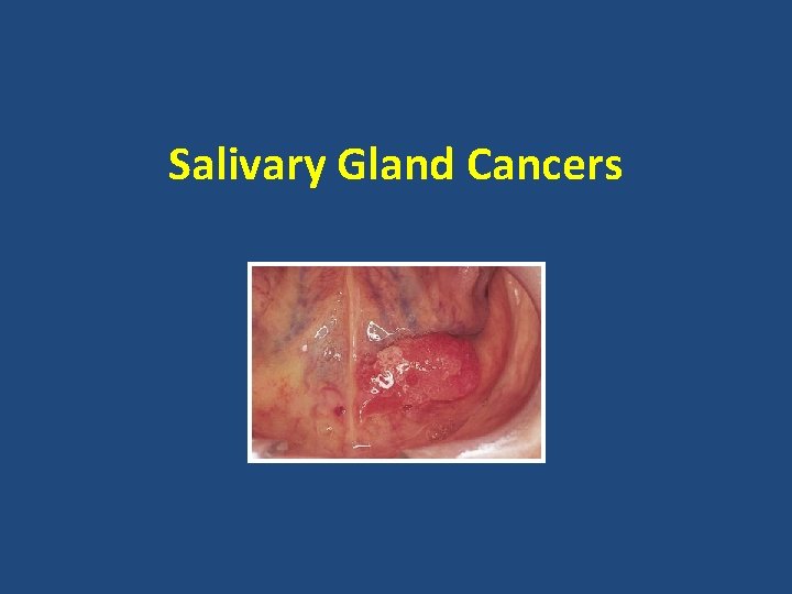 Salivary Gland Cancers 