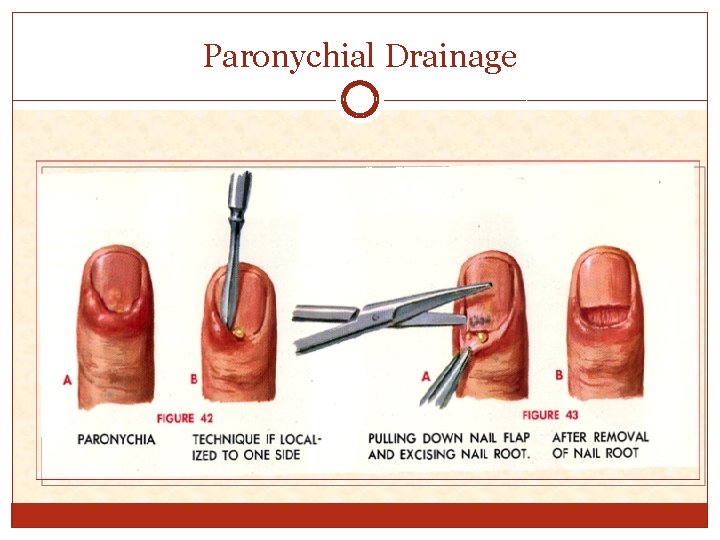 Paronychial Drainage 