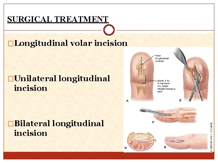 SURGICAL TREATMENT �Longitudinal volar incision �Unilateral longitudinal incision �Bilateral longitudinal incision 