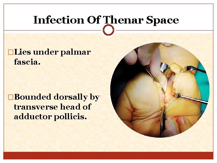 Infection Of Thenar Space �Lies under palmar fascia. �Bounded dorsally by transverse head of