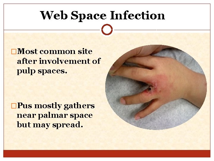 Web Space Infection �Most common site after involvement of pulp spaces. �Pus mostly gathers