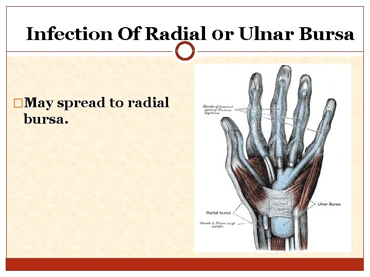Infection Of Radial 0 r Ulnar Bursa �May spread to radial bursa. 