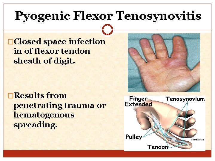 Pyogenic Flexor Tenosynovitis �Closed space infection in of flexor tendon sheath of digit. �Results