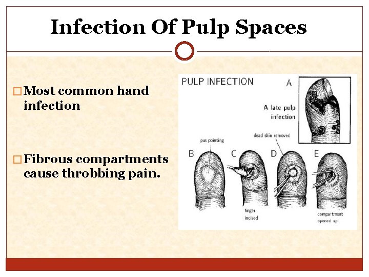 Infection Of Pulp Spaces � Most common hand infection � Fibrous compartments cause throbbing
