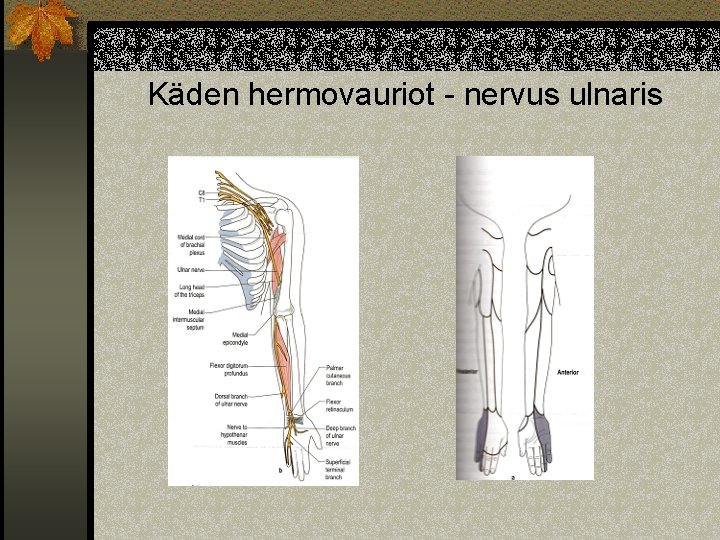 Käden hermovauriot - nervus ulnaris 