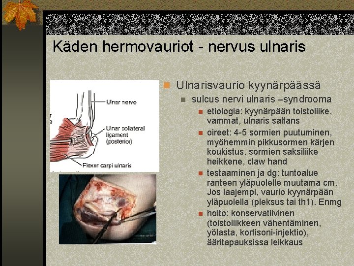 Käden hermovauriot - nervus ulnaris n Ulnarisvaurio kyynärpäässä n sulcus nervi ulnaris –syndrooma n