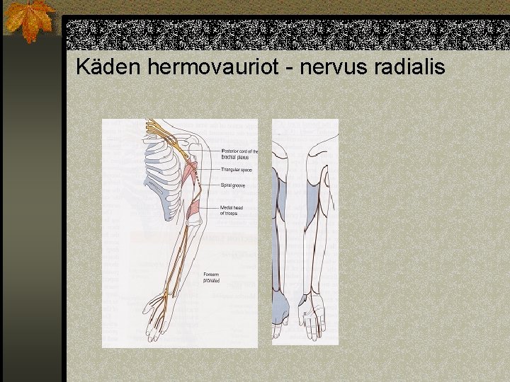 Käden hermovauriot - nervus radialis 