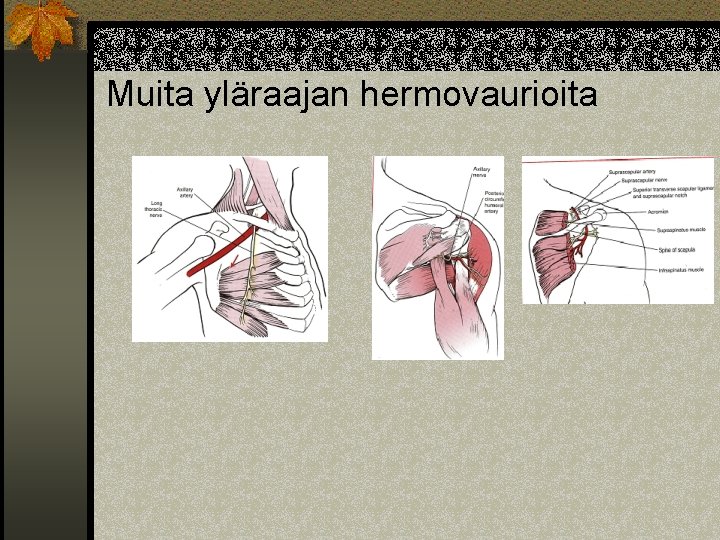 Muita yläraajan hermovaurioita 