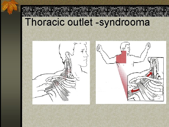 Thoracic outlet -syndrooma 