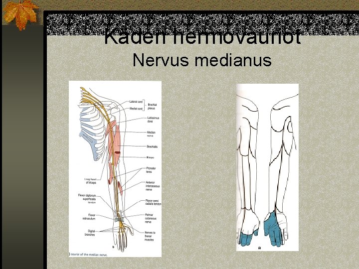 Käden hermovauriot Nervus medianus 