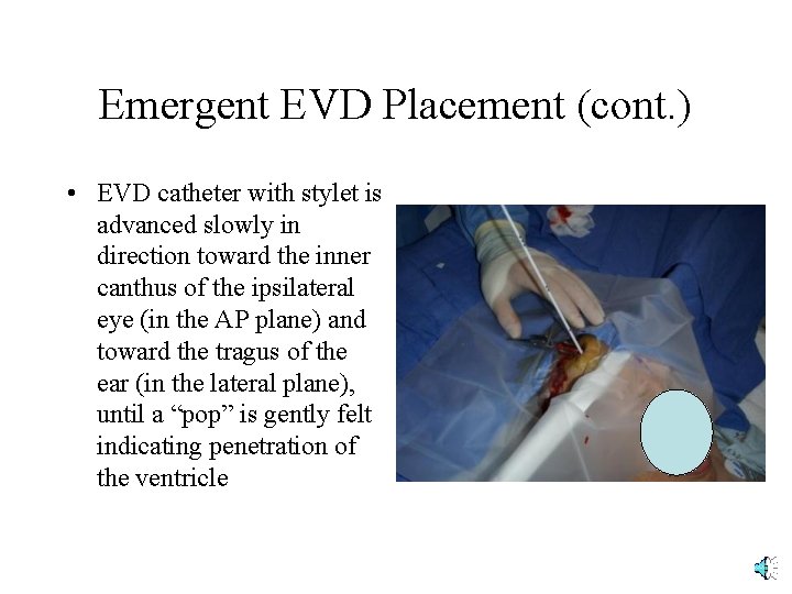 Emergent EVD Placement (cont. ) • EVD catheter with stylet is advanced slowly in