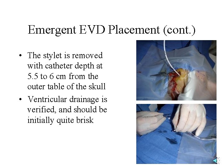 Emergent EVD Placement (cont. ) • The stylet is removed with catheter depth at