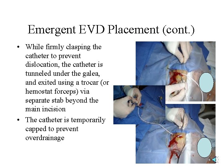 Emergent EVD Placement (cont. ) • While firmly clasping the catheter to prevent dislocation,