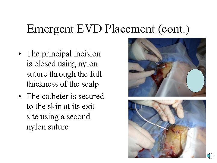Emergent EVD Placement (cont. ) • The principal incision is closed using nylon suture