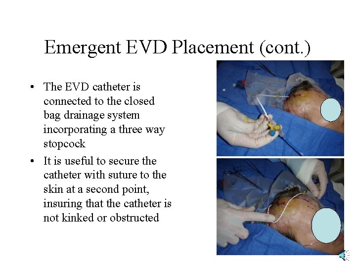 Emergent EVD Placement (cont. ) • The EVD catheter is connected to the closed