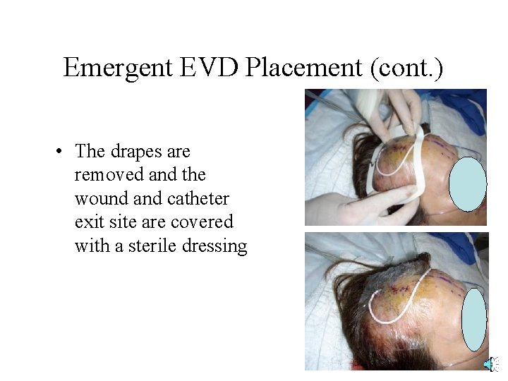 Emergent EVD Placement (cont. ) • The drapes are removed and the wound and